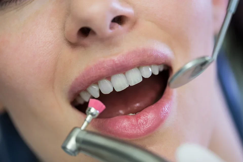 Dental Bonding-01