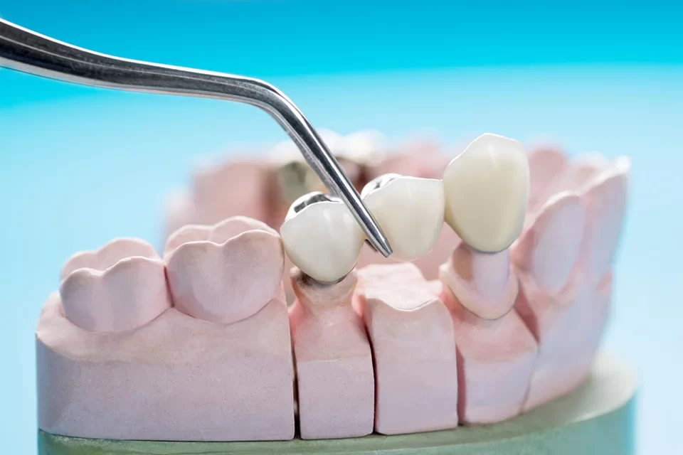 Dental Bridges-01