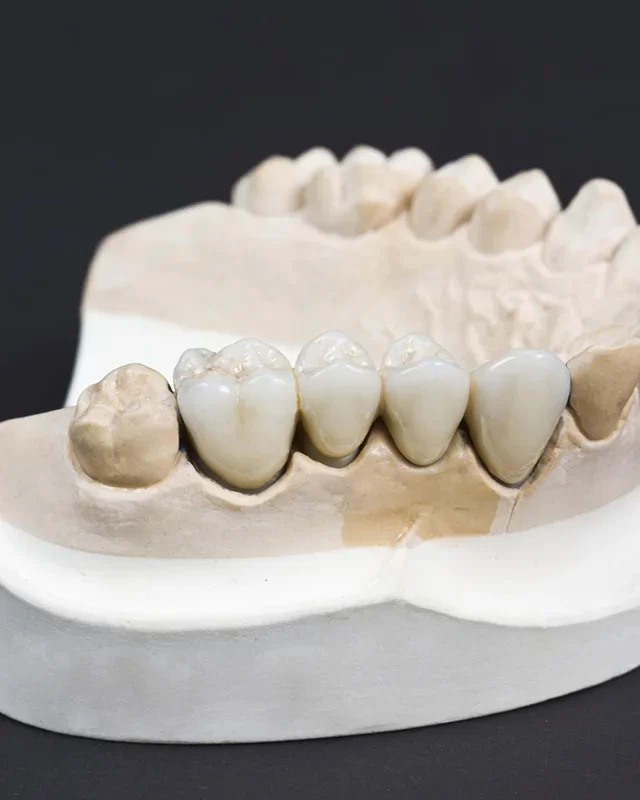 Dental Bridges-02