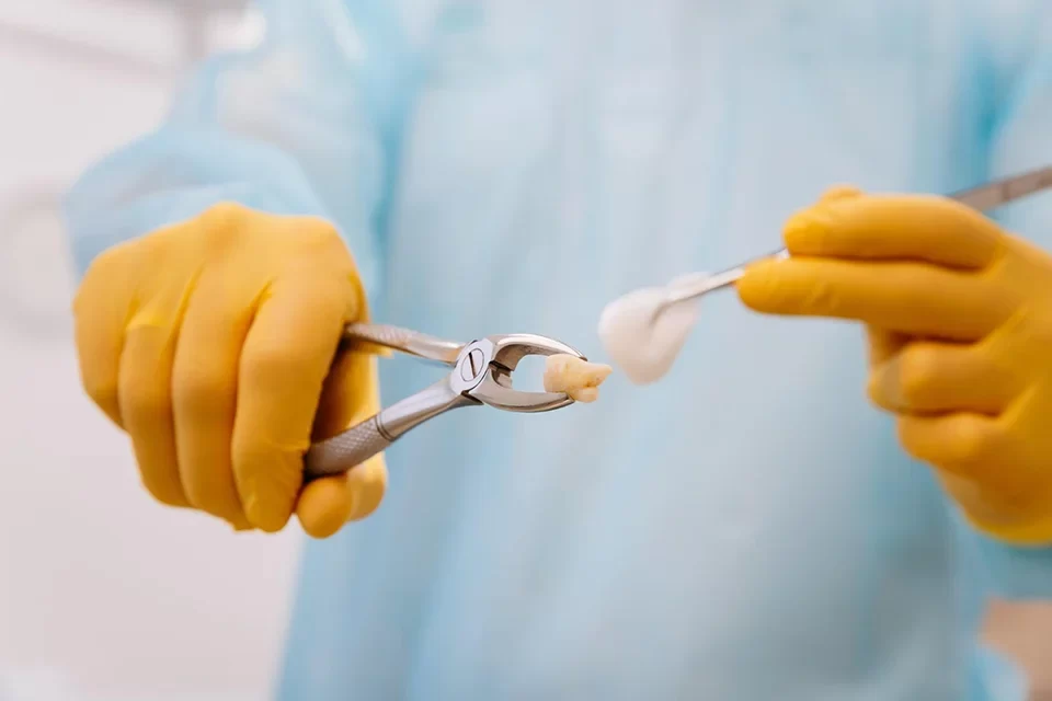 Dental Extraction-p1-v2