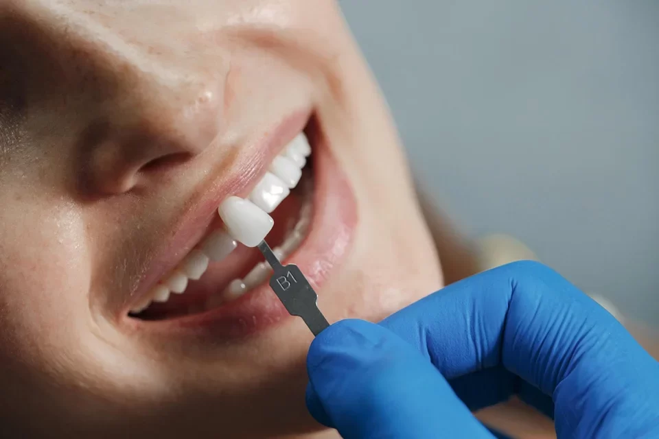 Dental Sealants-p1