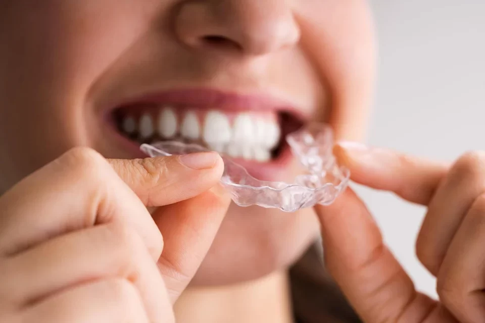 Invisalign-01