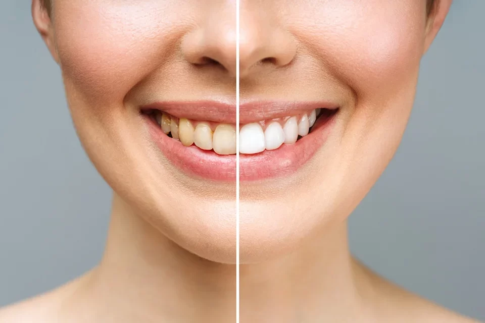Teeth Whitening-01